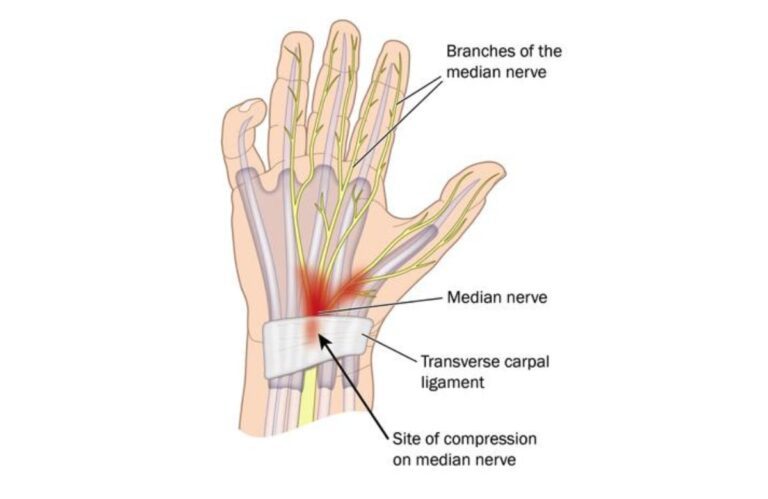 Carpal Tunnel Syndrome, Gejala dan Tips Mencegahnya
